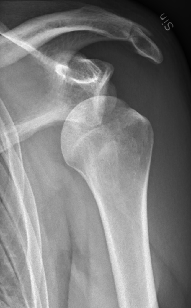 Shoulder Dislocation (Glenohumeral Joint Dislocation)